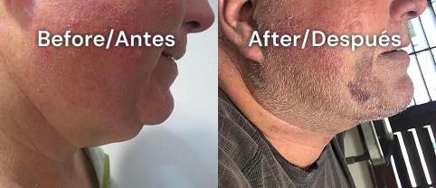 neckplasty case 2