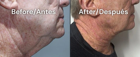 neckplasty san diego