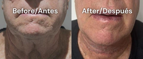 neckplasty tijuana